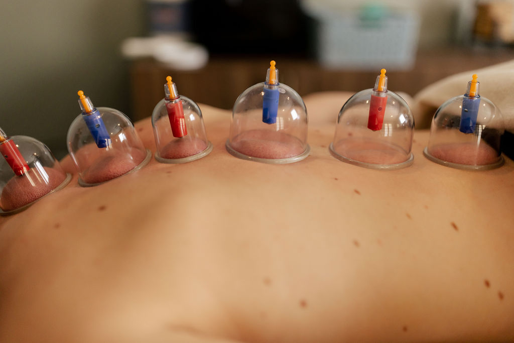 Cupping Massage Therapy in Brookfield, WI